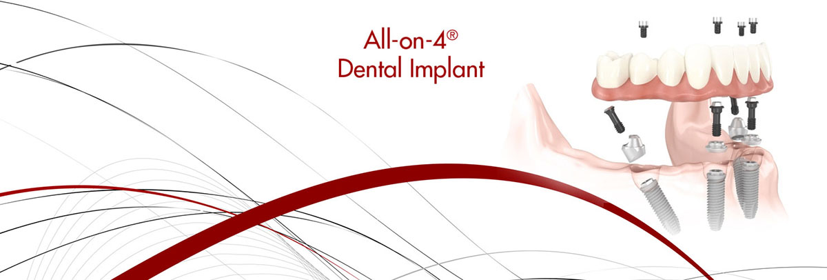 Long Grove All-on-4 Dental Implants