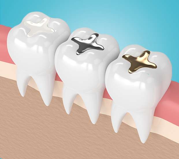 Long Grove Composite Fillings