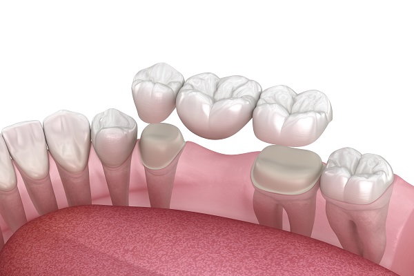 Dental Bridges Can Replace Missing Teeth