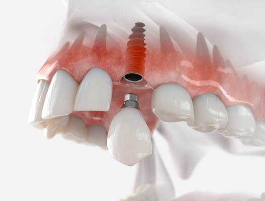Reasons To Choose Implants For Tooth Restoration