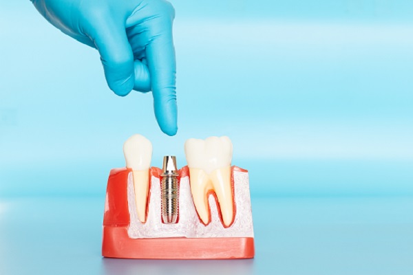 What Happens After Dental Implants Are Placed?