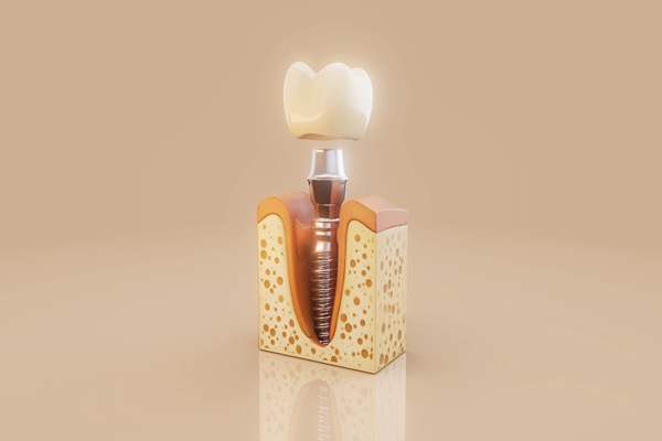 Get Dental Implants From An Experienced Implant Dentist