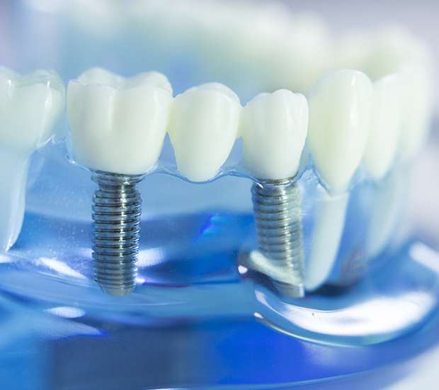 Long Grove Dental Implants