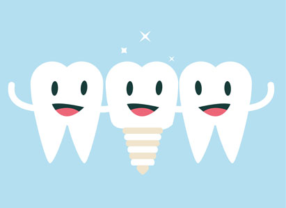 Dental Implants