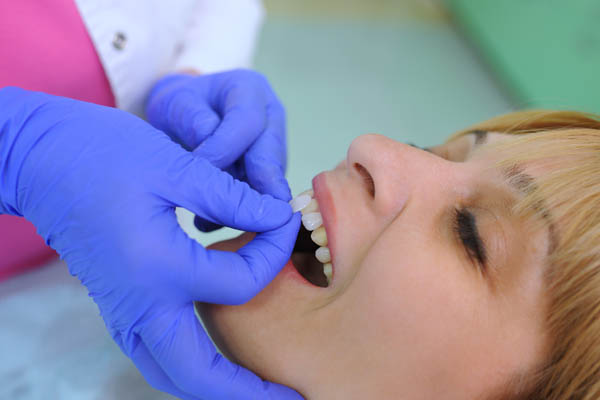 Ask A Cosmetic Dentist About The Dental Veneers Procedure