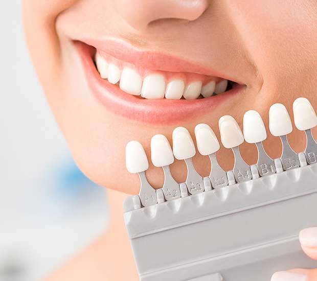 Long Grove Dental Veneers and Dental Laminates