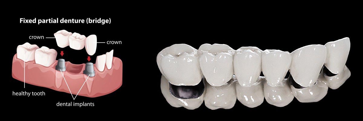 Long Grove Dentures
