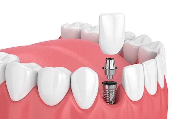 How Painful is Dental Implant Surgery from Long Grove Dental in Long Grove, IL