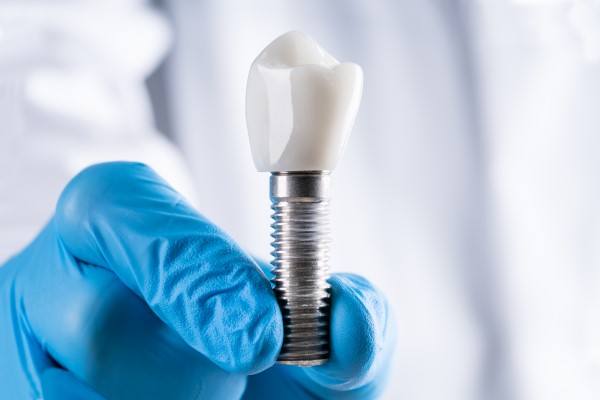 How An Experienced Implant Dentist Can Improve Your Smile