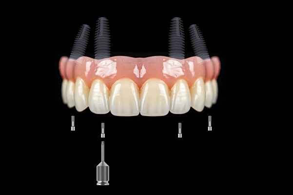 Reasons To Consider Implant Dentures To Replace Multiple Missing Teeth