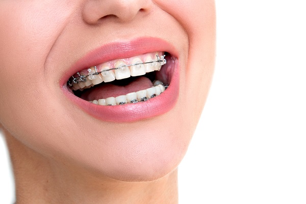Orthodontic Dental Office: Causes of Crooked Teeth - Long Grove