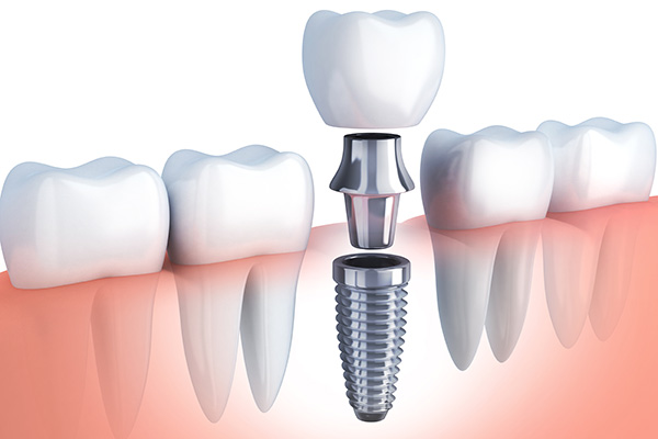 Questions to Ask Your Implant Dentist from Long Grove Dental in Long Grove, IL