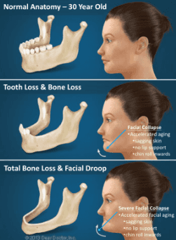 tooth-extraction-bone-loss