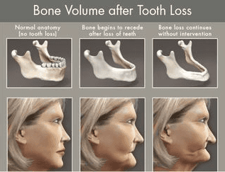 wisdom teeth before and after