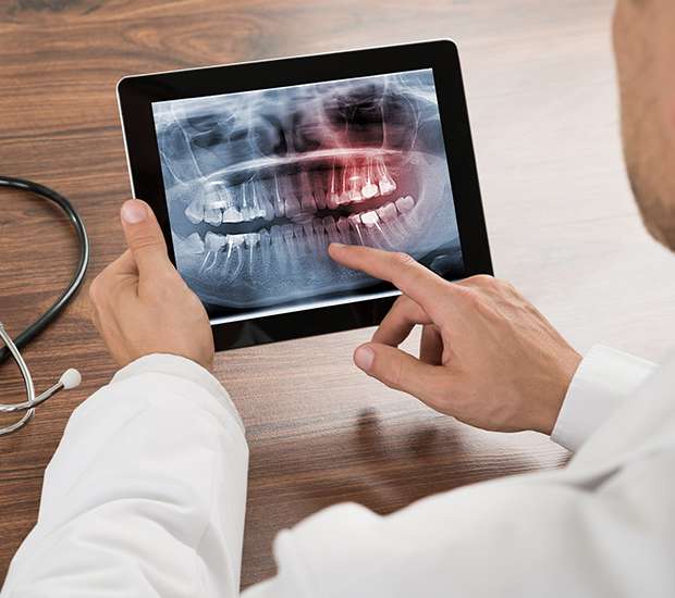 Long Grove Types of Dental Root Fractures