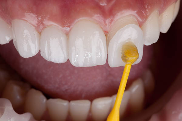 When Would A Dentist Recommend Dental Veneers?