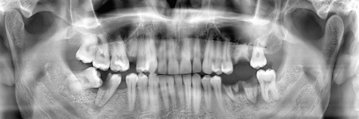 Long Grove Wisdom Teeth Extraction