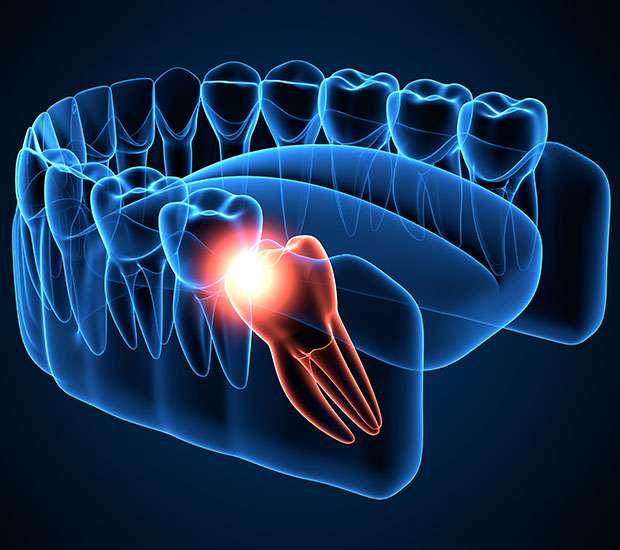 Long Grove Wisdom Teeth Extraction